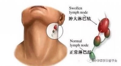 ​淋巴结是什么东西 淋巴结——你该了解的小知识